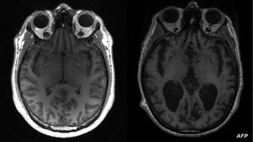“اكتئاب وقلق وشيخوخة”.. دراسة جديدة تكشف أثر إغلاقات كورونا على أدمغة المراهقين